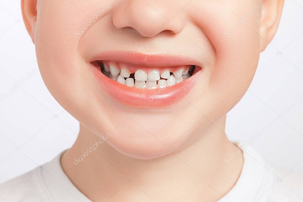 Closeup of child milk teeth with gaps between them. Diaeresis, diastema treatment concept. Dental problem.