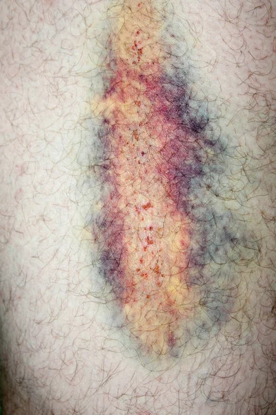 Hematomas enorme na perna macho.. foto — Fotografia de Stock