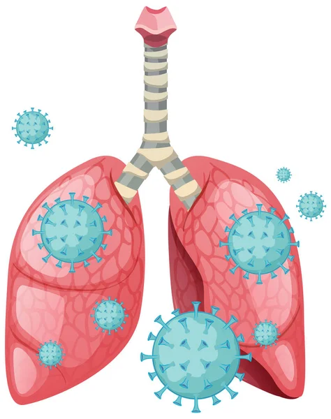 人間の肺中のコロナウイルス細胞 — ストックベクタ