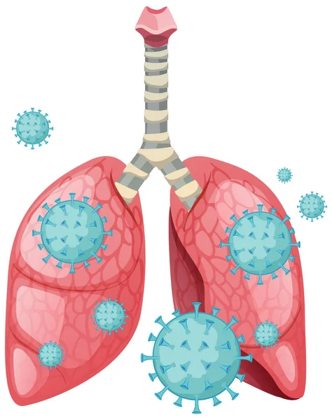 Коронавирусные клетки по всему легкому человека — стоковый вектор