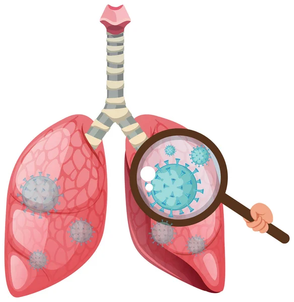 Pulmones Humanos Con Células Coronavirus Que Propagan Sobre Fondo Blanco — Vector de stock