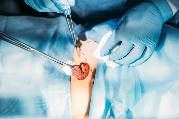 Cropped Image Surgeons Operating Patient Abdomen Operating Room — Stock Photo, Image