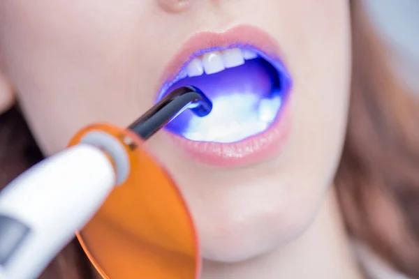 Paciente y luz de curado dental - foto de stock