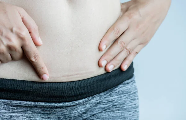 Nahaufnahme einer Frau, die auf ihrem Bauch eine dunkle Narbe vom Kaiserschnitt zeigt. — Stockfoto