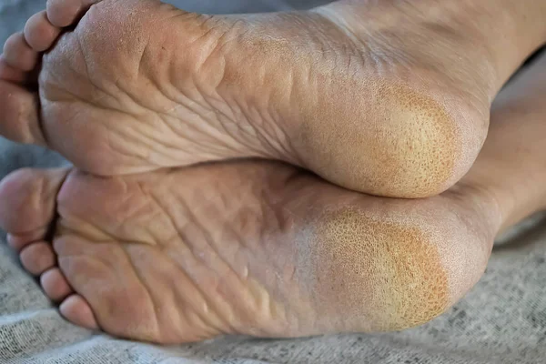 Diyabeti Olan Bir Hastanın Ayakları Şeker Hastası Ayağı Hiperkeratoz Ayak — Stok fotoğraf