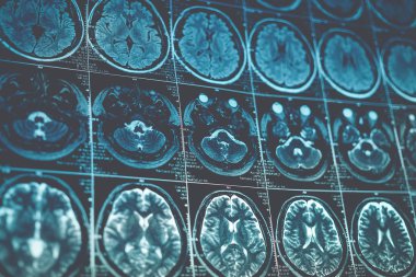 MRI ya da manyetik rezonans görüntüsü baş ve beyin taraması. Tonda görünümü kadar kapat