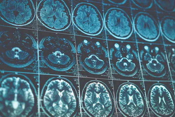 MRI vagy a mágneses rezonancia kép a fej és az agy scan. Zár megjelöl kilátás, tónusú — Stock Fotó