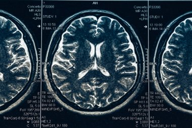 MRI beyin tomografisi veya x-ışını Nöroloji insan kafa kafatası tomografi testi