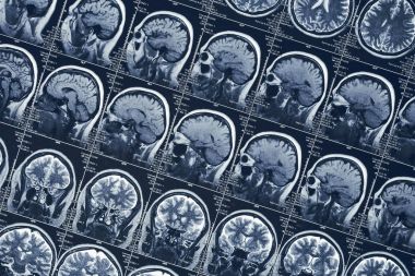 MRI beyin tomografisi veya x-ışını Nöroloji insan kafa kafatası tomografi testi