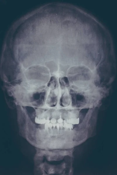 Рентгенівське зображення або рентген людського черепа, крупним планом. Голова рентгенівського сканування голови скелета. Абстрактна медична концепція — стокове фото