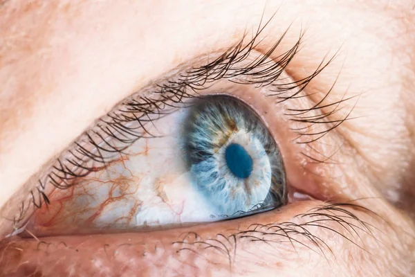 Red female blue eye close up macro photo. Swollen eyelids, foreign body pain — Stock Photo, Image