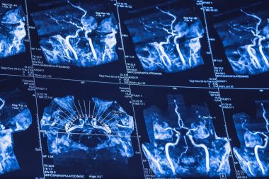 MRI tarama beyin beyin damarlarının, tomografi - iç vertebral arter, Karotid arter ve onların dallanma projeksiyon X-Ray