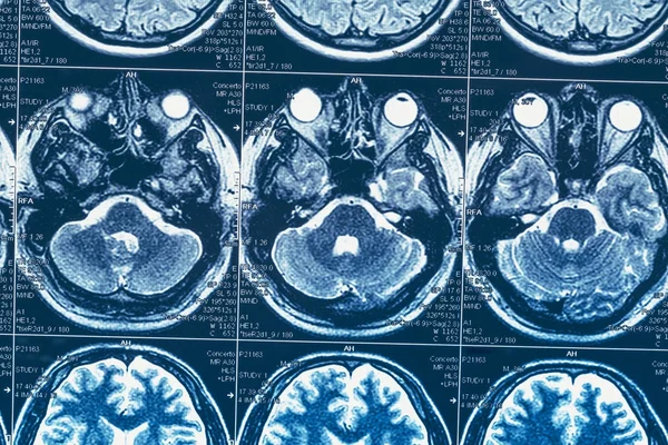 MRI vagy a mágneses rezonancia kép a fej és az agy scan — Stock Fotó