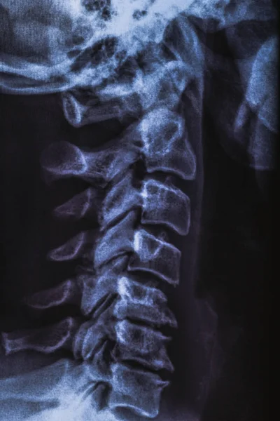 X-ray radiografie nebo rentgen lidské krku, lékařská radiologie koncept — Stock fotografie
