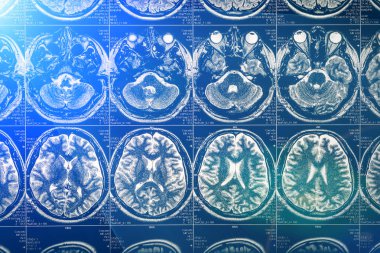 Beyin tarama X-ray MRI veya manyetik rezonans görüntüleme insan kafa, Nöroloji kavramının