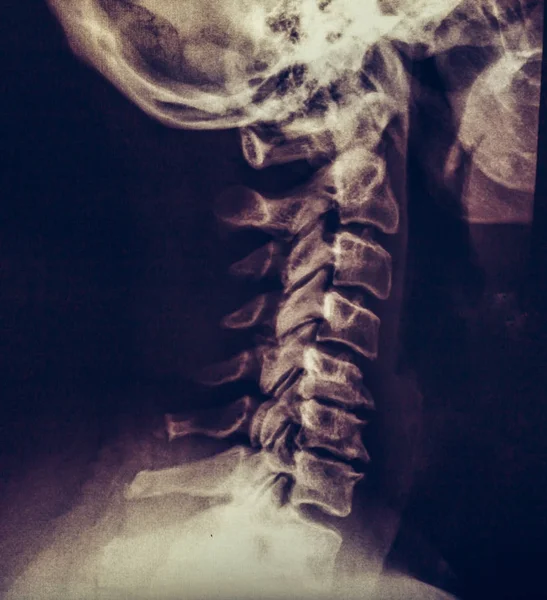 X-ışını insan boyun, omur veya omurga — Stok fotoğraf