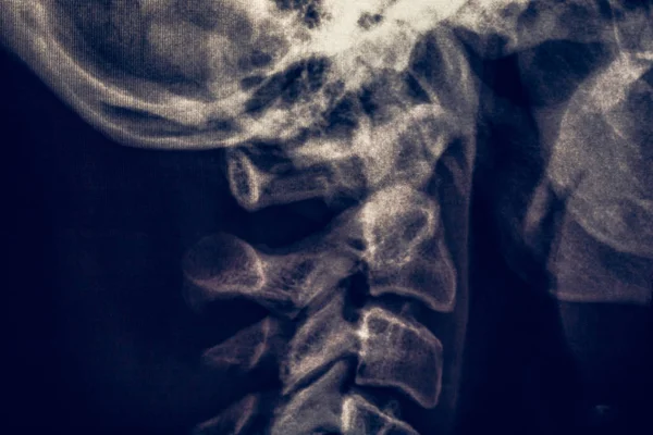X-ray radiografie nebo rentgen lidské krku, lékařská radiologie koncept — Stock fotografie