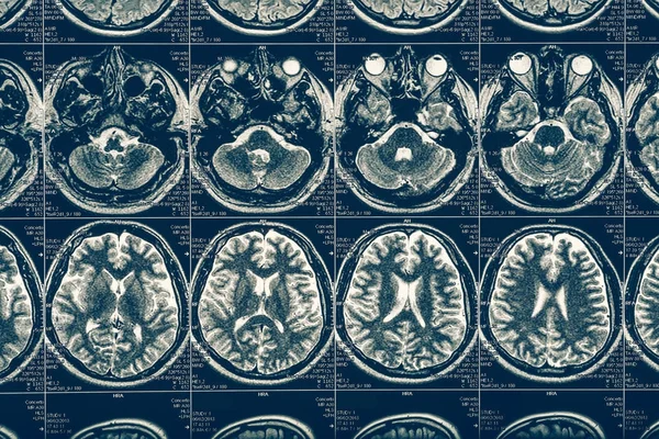 Számítógépes tomográfia röntgen agy scan kép, belső hydrocephalus, neurológia — Stock Fotó
