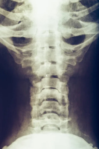 人颈部、脊椎或脊柱的 x 线 — 图库照片