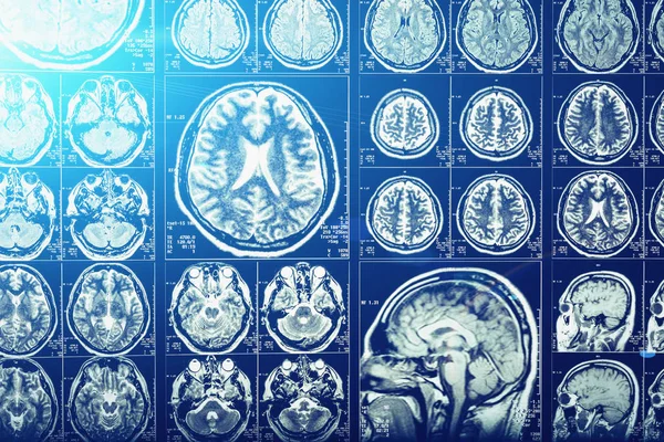 Kompromisszumai fejét, agy vagy evez scan röntgenkép, kék fény hatása, neurológia — Stock Fotó