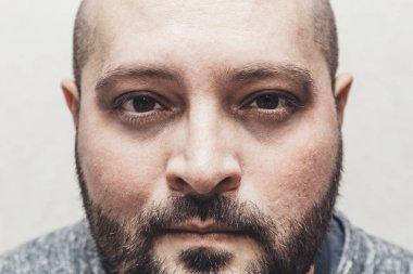 Gözlerinin altında torbalar ile vurguladı yorgun üzgün adam portresi kamera, uykusuzluk ve depresyon kavramı görünüyor