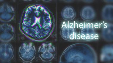 Alzheimer hastalığı veya Parkinson kavramı. Bulanık MRI tarama aksaklık etkisi ile beynin