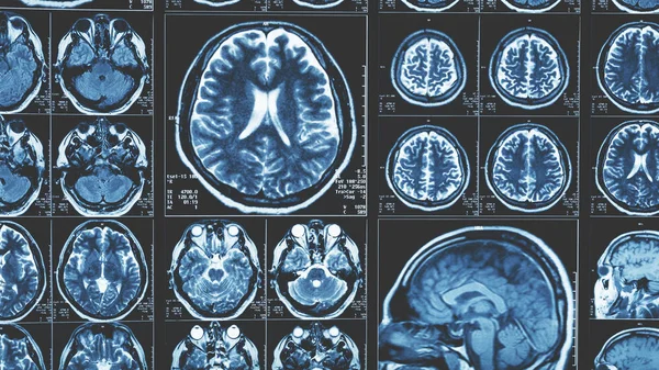 MRI az agy scan háttér, mágneses rezonancia tomográfia — Stock Fotó