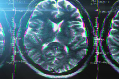 X-ışını veya MRI beyin taraması aksaklık etkisi ile. Alzheimer hastalığı ve diğer sağlık sorunları ile baş, beyin, bellek ve zihinsel sorunlar soyut kavram