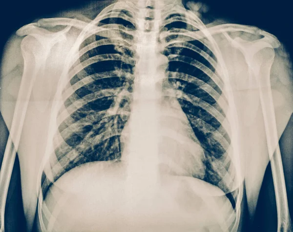 X-ışını bir insan göğüs ya da akciğerler Radyografi vurdu, tıp teknolojisi ve röntgen Klinik teşhis kavramı — Stok fotoğraf