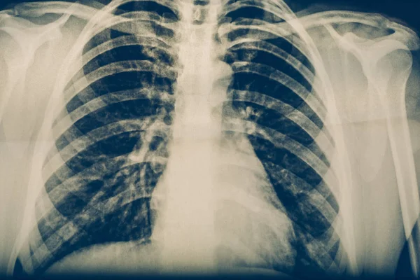 X-ışını bir insan göğüs ya da akciğerler Radyografi vurdu, tıp teknolojisi ve röntgen Klinik teşhis kavramı — Stok fotoğraf