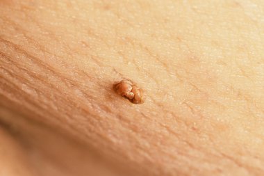 Deri etiketi ya da akrokordon ya da yumuşak fibroma ya da erkek koltuk altında ben, makro fotoğraf. Papilloma virüsü ya da tümör, cilt konseptinde dermatoloji problemi