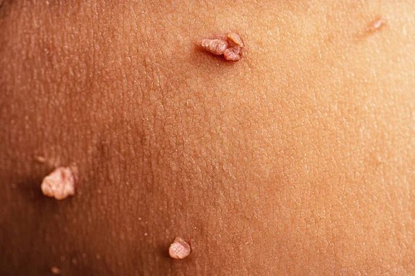 Skin tag or acrochordon or soft fibroma or mole in male armpit, macro photo. Papilloma virus or bump, dermatology problem on skin concept — 스톡 사진