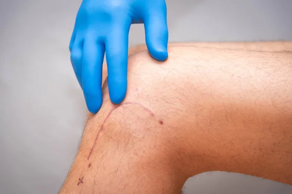 Sutura Postoperatoria Rodilla Una Mano Guante Médico Azul Sostiene Pierna — Foto de Stock