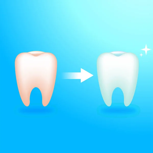 더럽고 깨끗 한 치아입니다. 치과에서 치료입니다. 아픈 치아 — 스톡 벡터